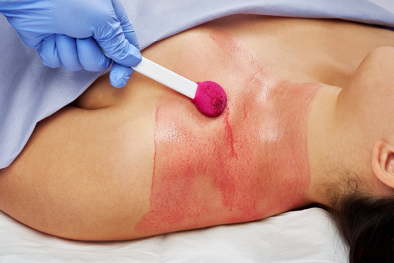 3M SoluPrep Large Swab 102.09 (tinted) being applied to the upper chest