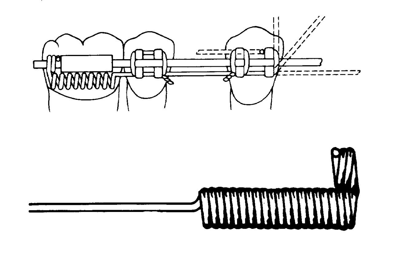 3M™ Unitek™ T Spring