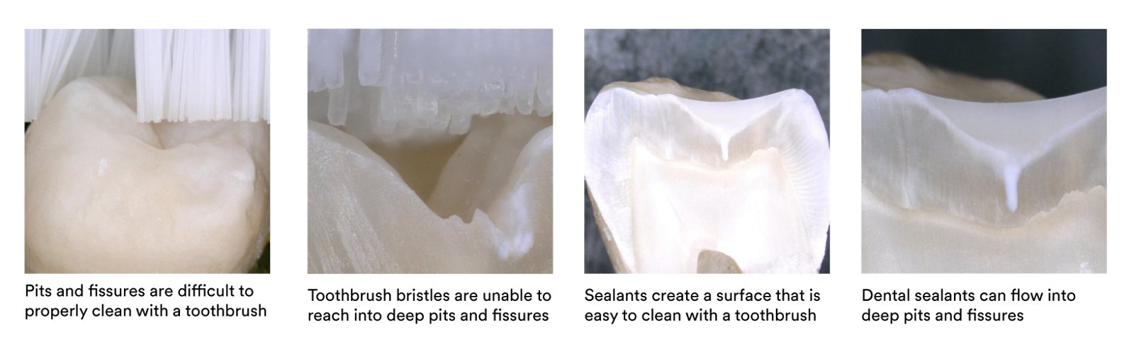 Informative oral care related imagery with a file name of Patricia_Gaton_Fig7_rz.jpg shown on Solventum's "Brain Floss" blog