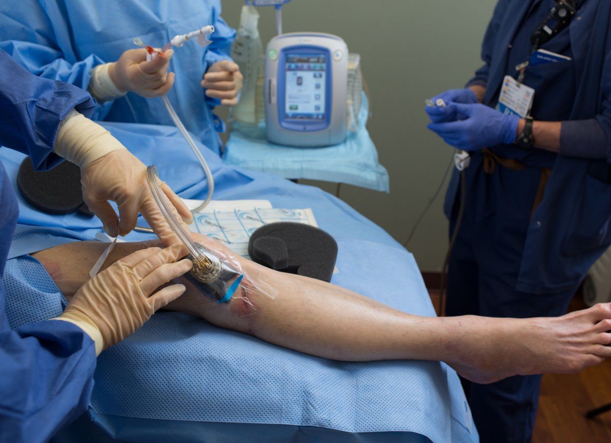 VAC GranuFoam Application - Knee
