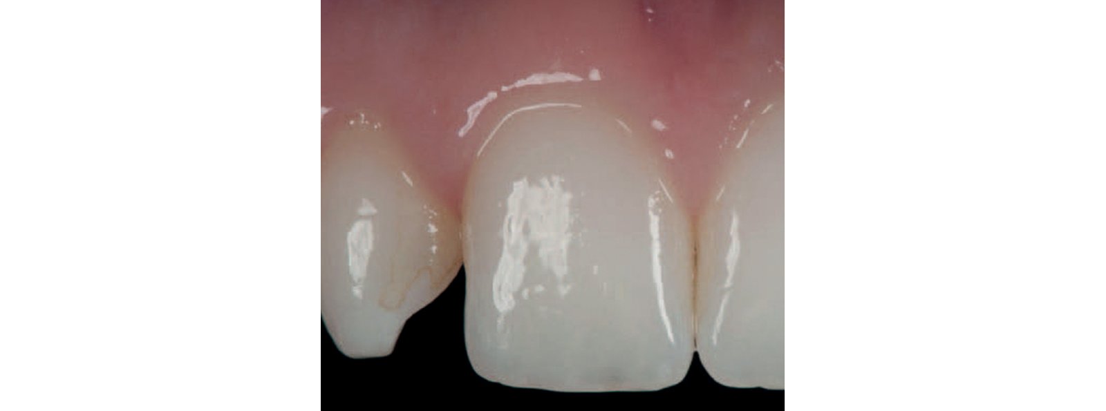 Closer view of small laterals