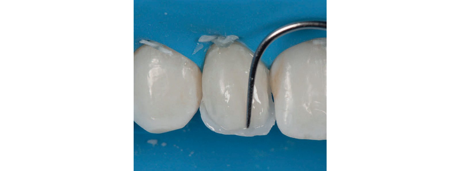 3M Filtek Supreme Ultra Universal Restorative placed