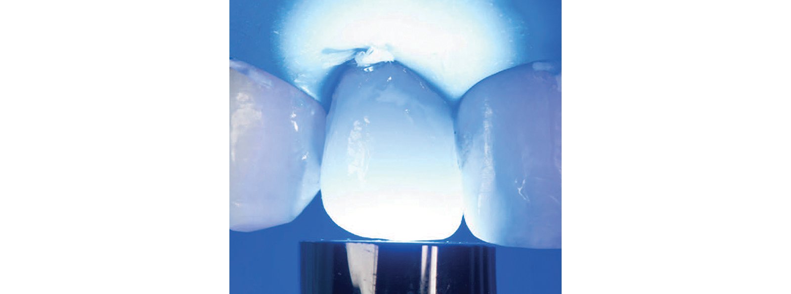 Light cured restoration