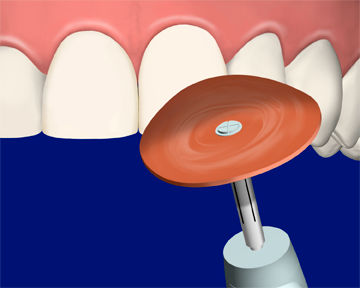 Illustration of Veneer Matrix Contouring with Bur and Sof-Lex