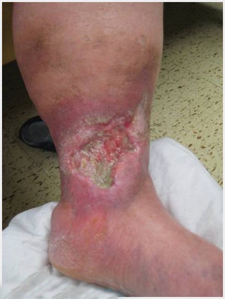 Venous leg ulcer, advanced wound dressing, AWD, clinical image, cmyk, jpg