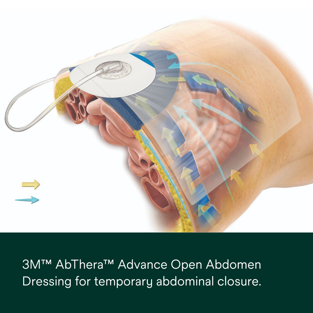 AbThera Advance Open Abdomen Dressing PDP Secondary Image 1