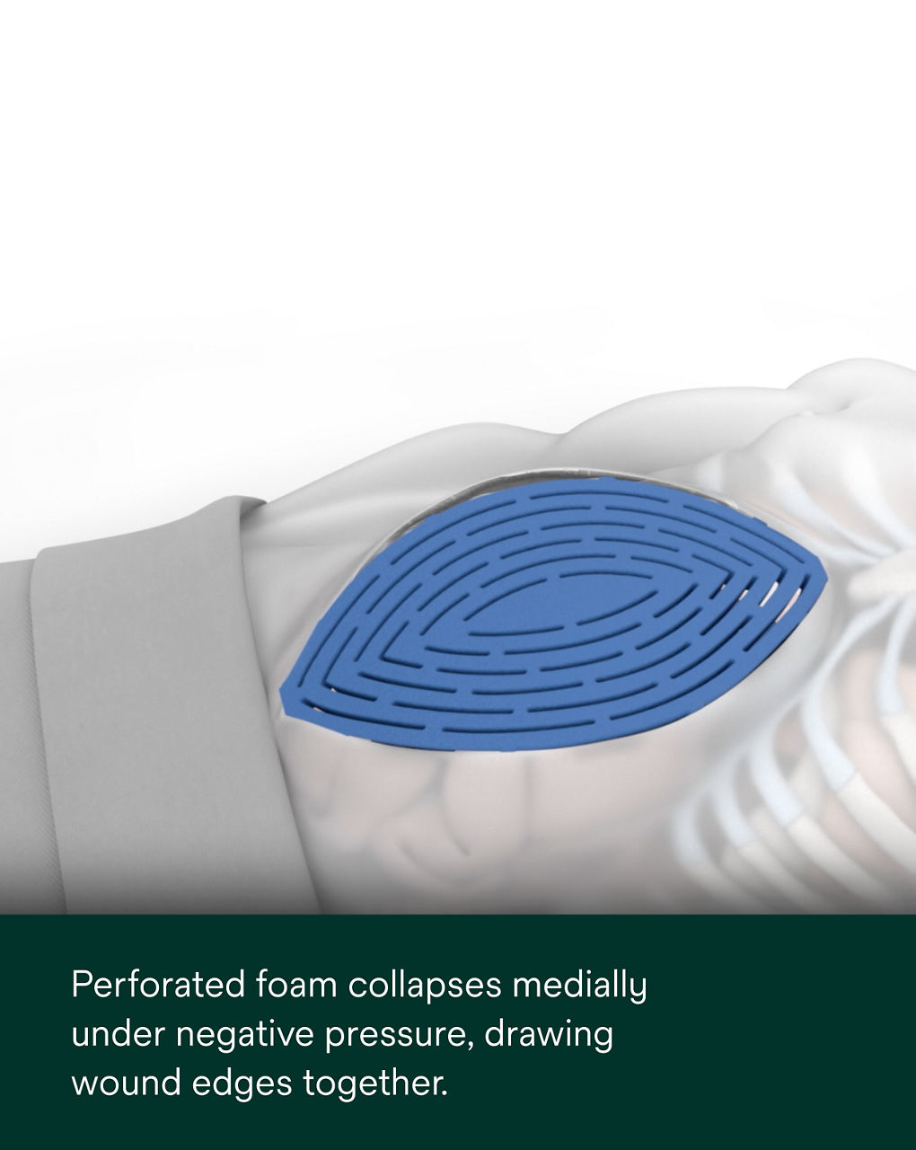 AbThera Advance Open Abdomen Dressing PDP Secondary Image 3