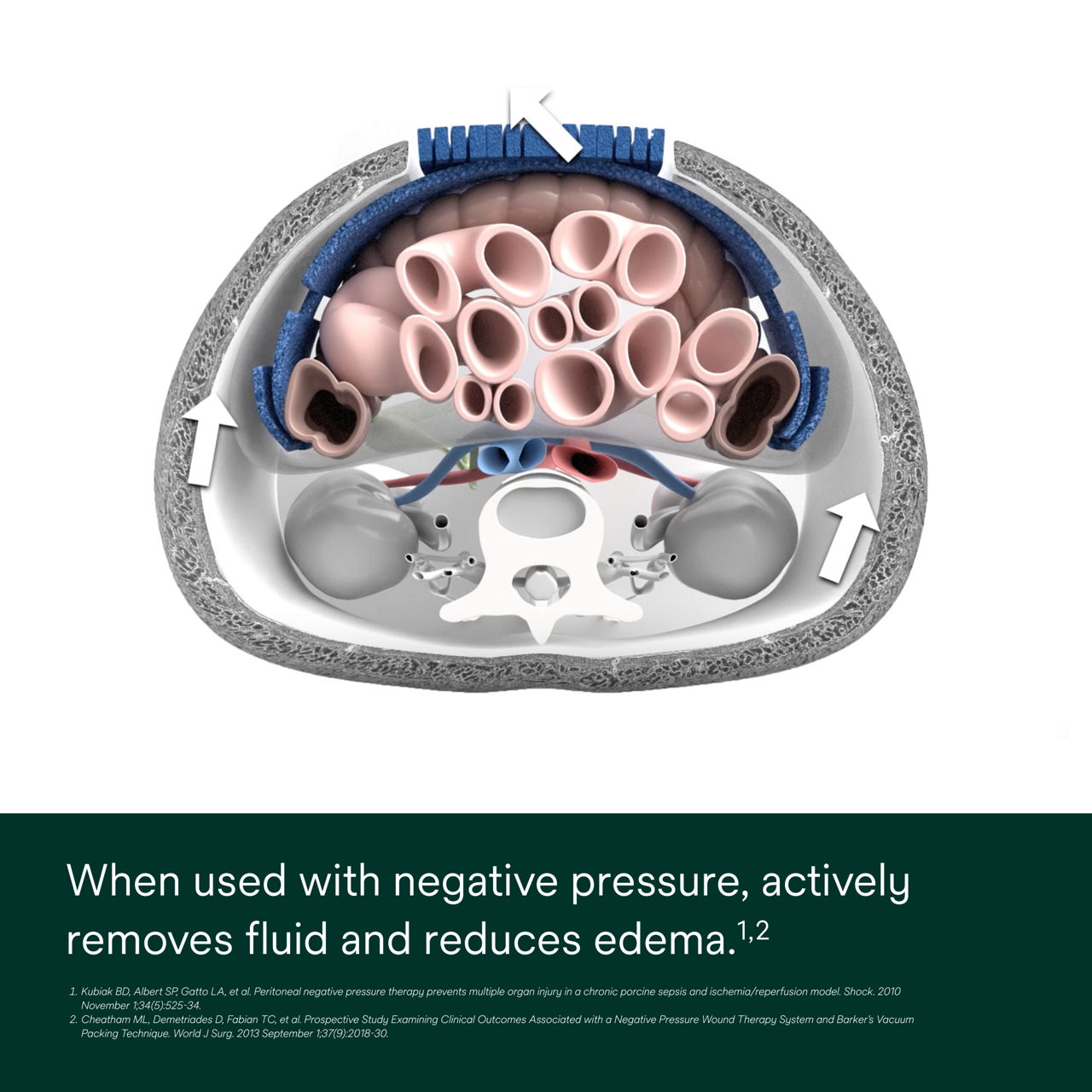 AbThera Advance Open Abdomen Dressing PDP Secondary Image 4