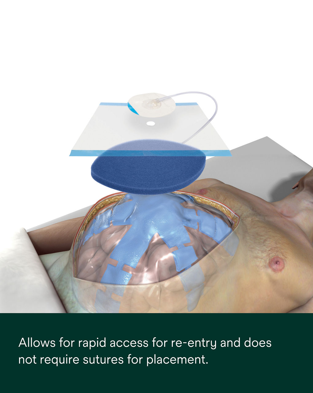 AbThera Advance Open Abdomen Dressing PDP Secondary Image 8