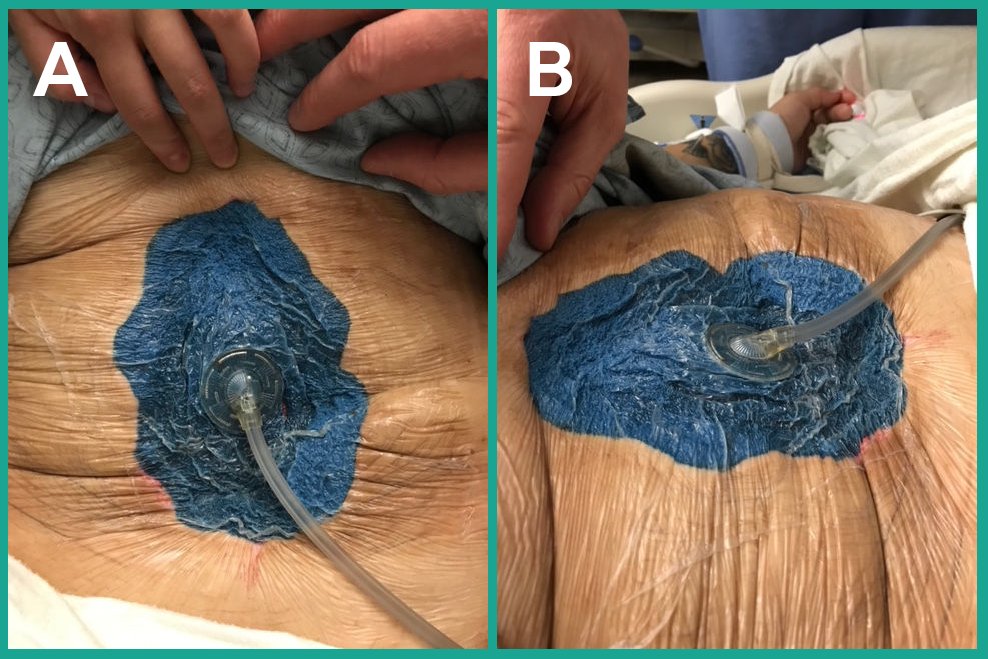 Dr. Marc Matthews case study images: Open abdomen placement of 3M™ AbThera™ Advance Open Abdomen Dressing for temporary abdominal closure following removal of necrotic small bowel. AbThera Advance Dressing placement after small bowel resection (A) + patient in supine position (B).