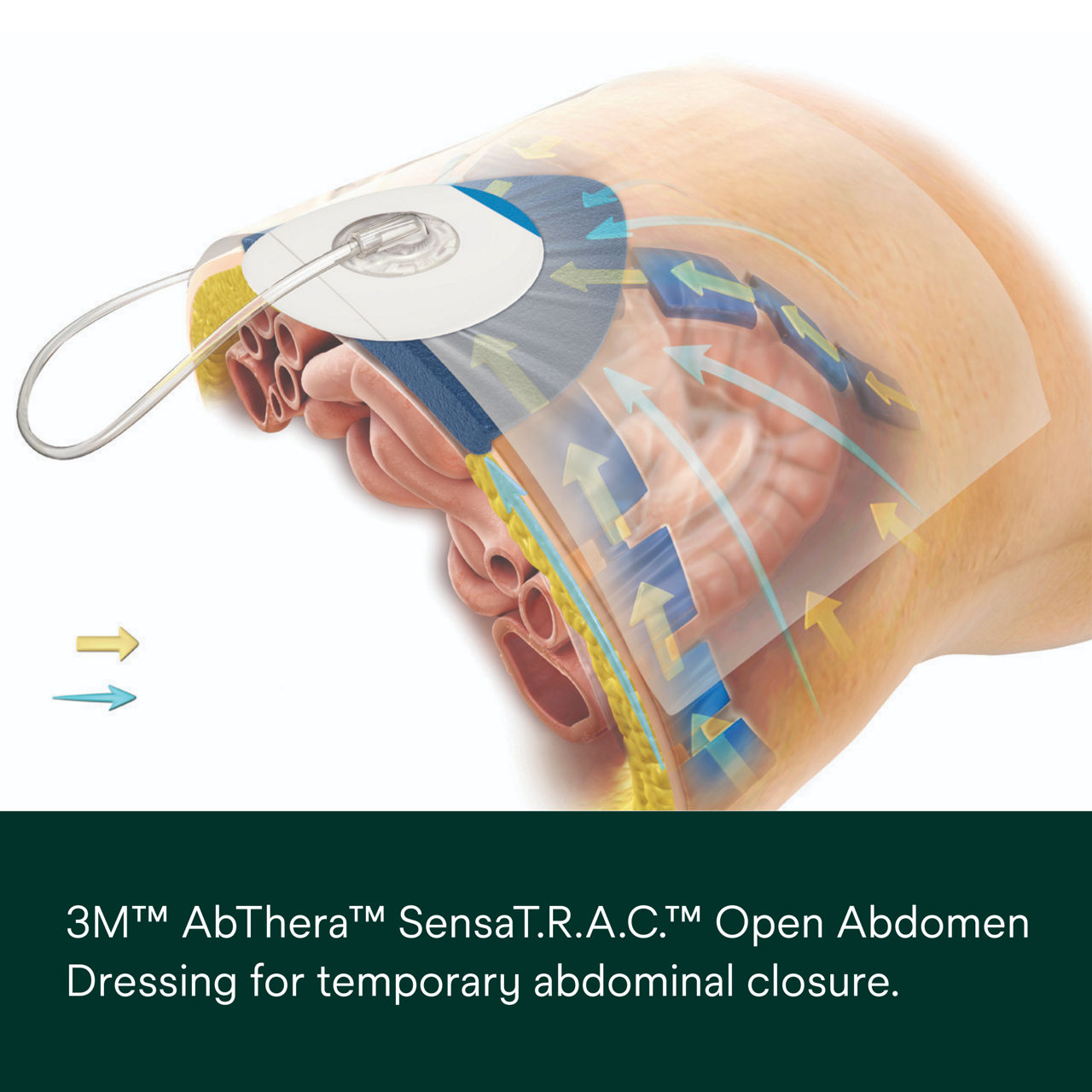 AbThera SensaT.R.A.C. Open Abdomen Dressing PDP Secondary Image 1