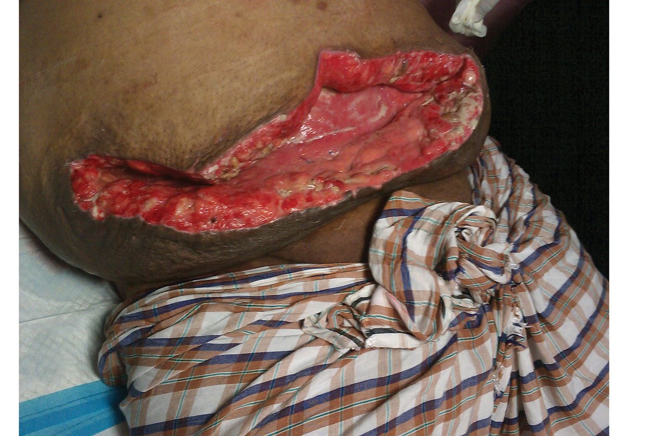 Immagine di una ferita acuta, immagine clinica chirurgica dello stomaco