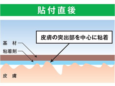adhesion