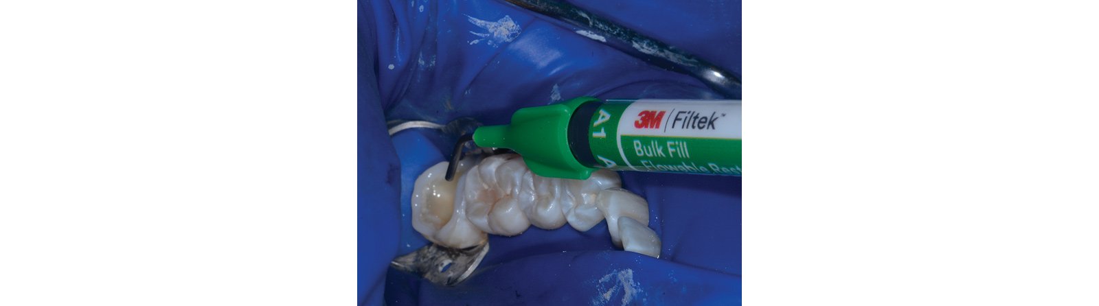 After adhesive application and 10 second light curing