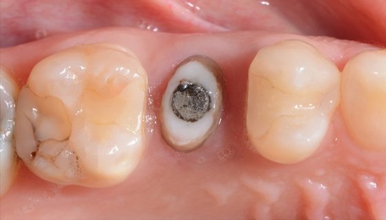 Situation after endodontic treatment