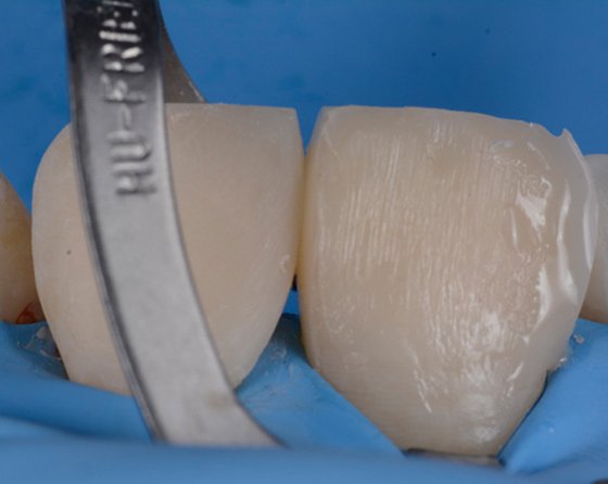 Distal and mesial contours are optimized