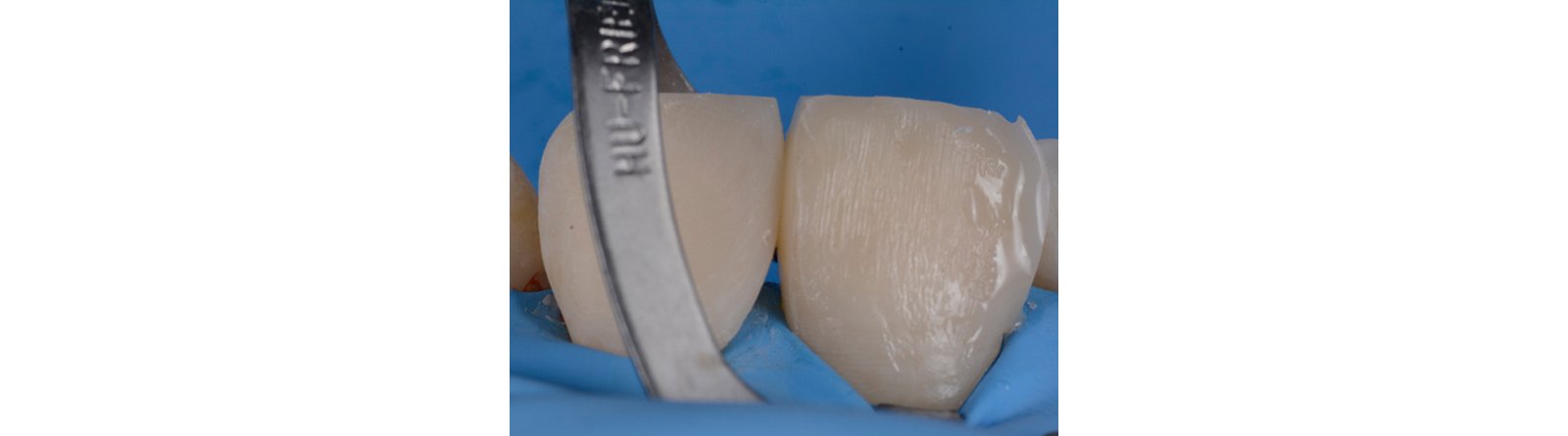 Distal and mesial contours are optimized