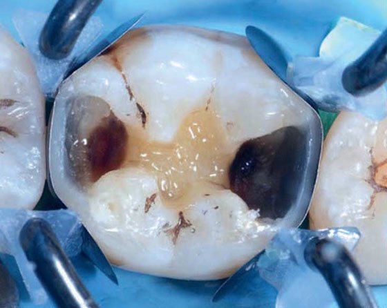 After build-up of proximal composite walls using the matrix system as a guide