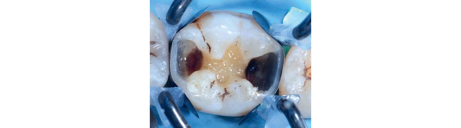 After build-up of proximal composite walls using the matrix system as a guide