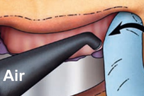 Measures facilitating removal of the impression from the mouth