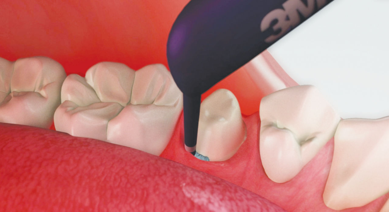 Module 2.1 - Astringent Retraction Paste: Insert retraction capsule tip into sulcue