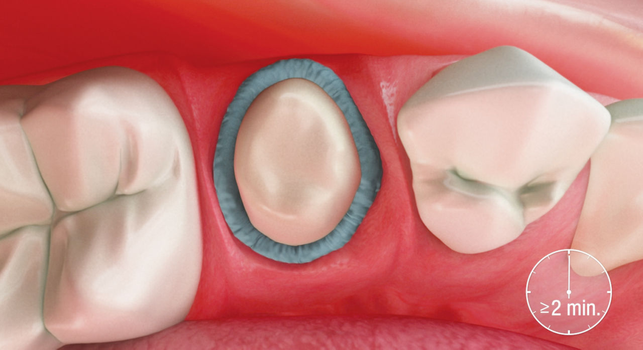 Module 2.3 - Astringent Retraction Paste: Leave in place for 2 min