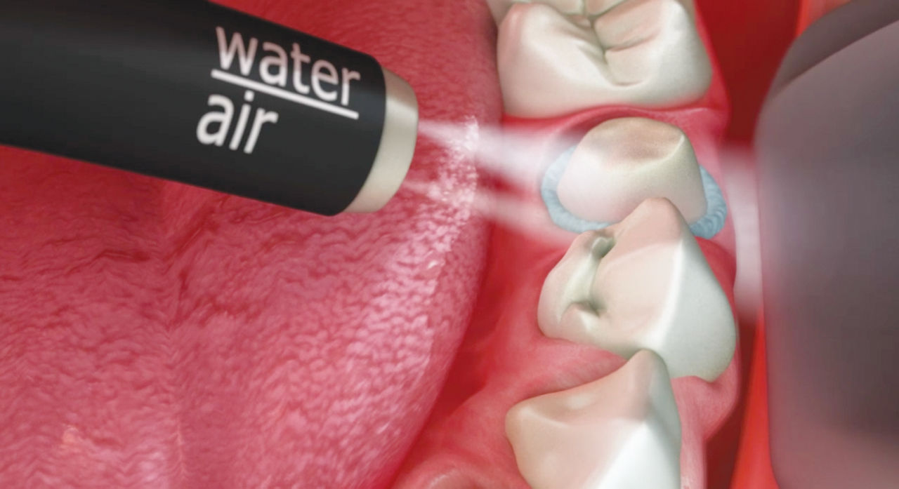 Module 2.4 - Astringent Retraction Paste: Remove with air-water spray and suction