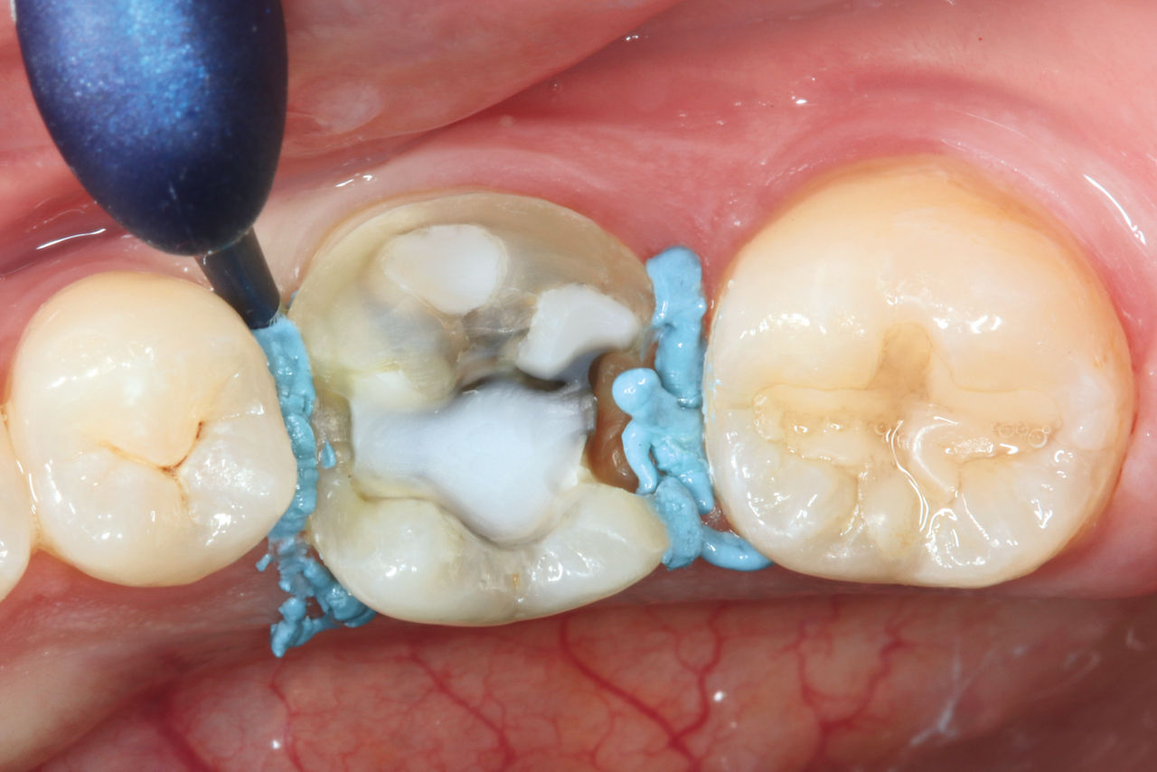 Module 3.1 - Astringent Retraction Paste: Case Study impressions for crown replacement