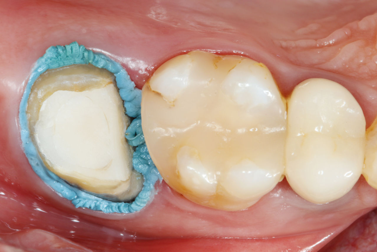 Module 3.3 - Astringent Retraction Paste: Case Study moisture management