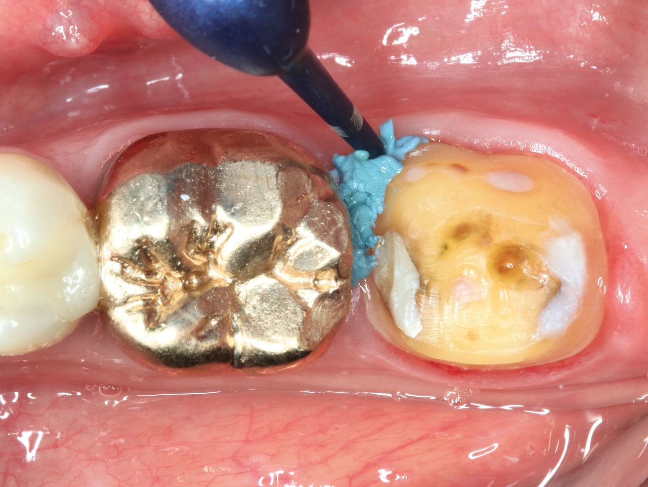 Module 3.2 - Astringent Retraction Paste: Case Study access to the margin without cords