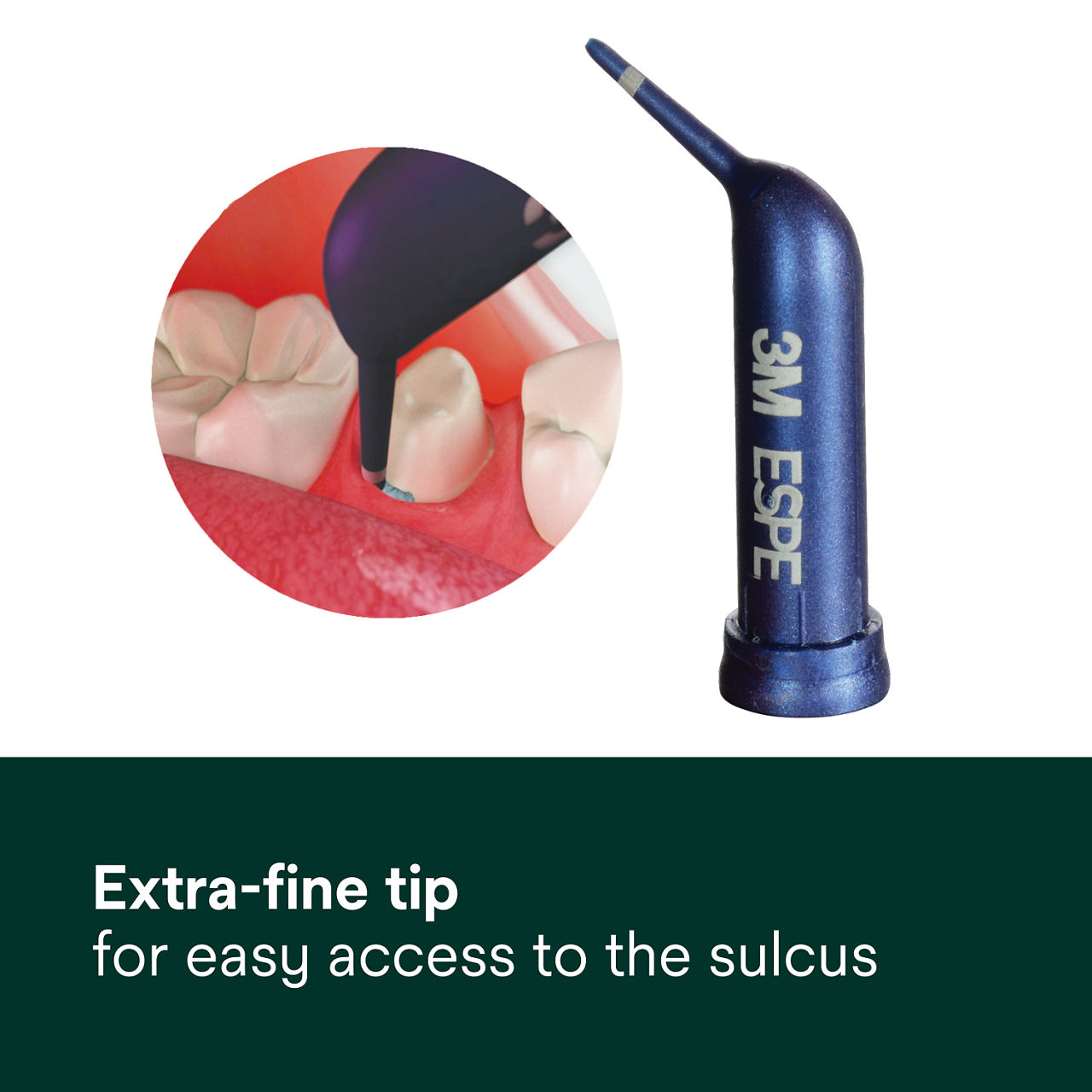 Extra-fine tip for easy access to the sulcus