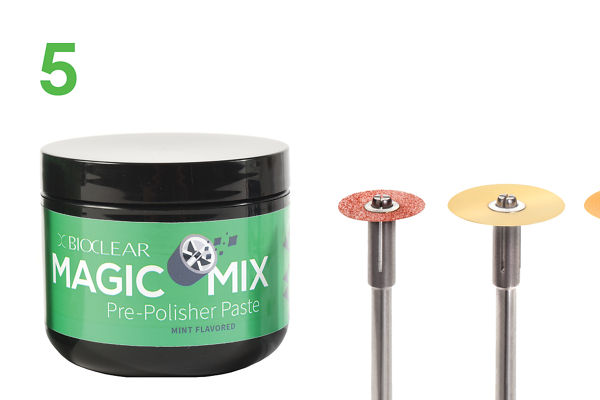 Step 5 of 5 steps of the Bioclear™ Method, shaping and polishing with 3M™ Sof-Lex™ Contouring and Polishing Discs and Bioclear MagicMix Pre-Polisher Paste