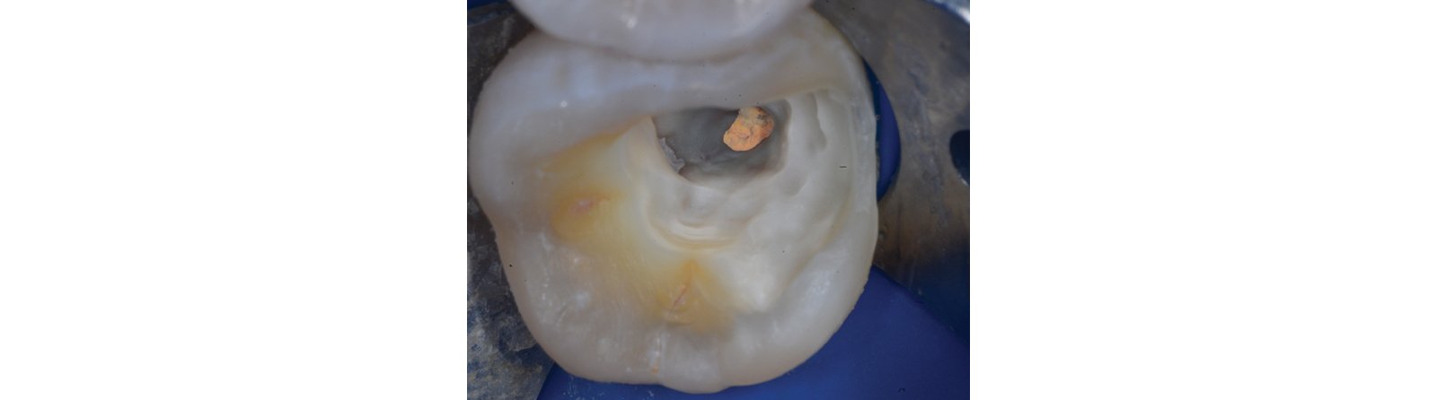 Endodontic therapy is complete and caries removal is confirmed
