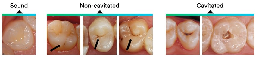 Informative oral care related imagery with a file name of 3M_StyleItaliano_Blogbeitrag_2.png shown on Solventum's "Brain Floss" blog