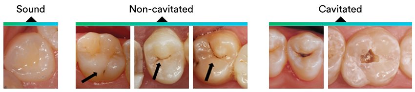 Informative oral care related imagery with a file name of 3M_StyleItaliano_Blogbeitrag_2.png shown on Solventum's "Brain Floss" blog