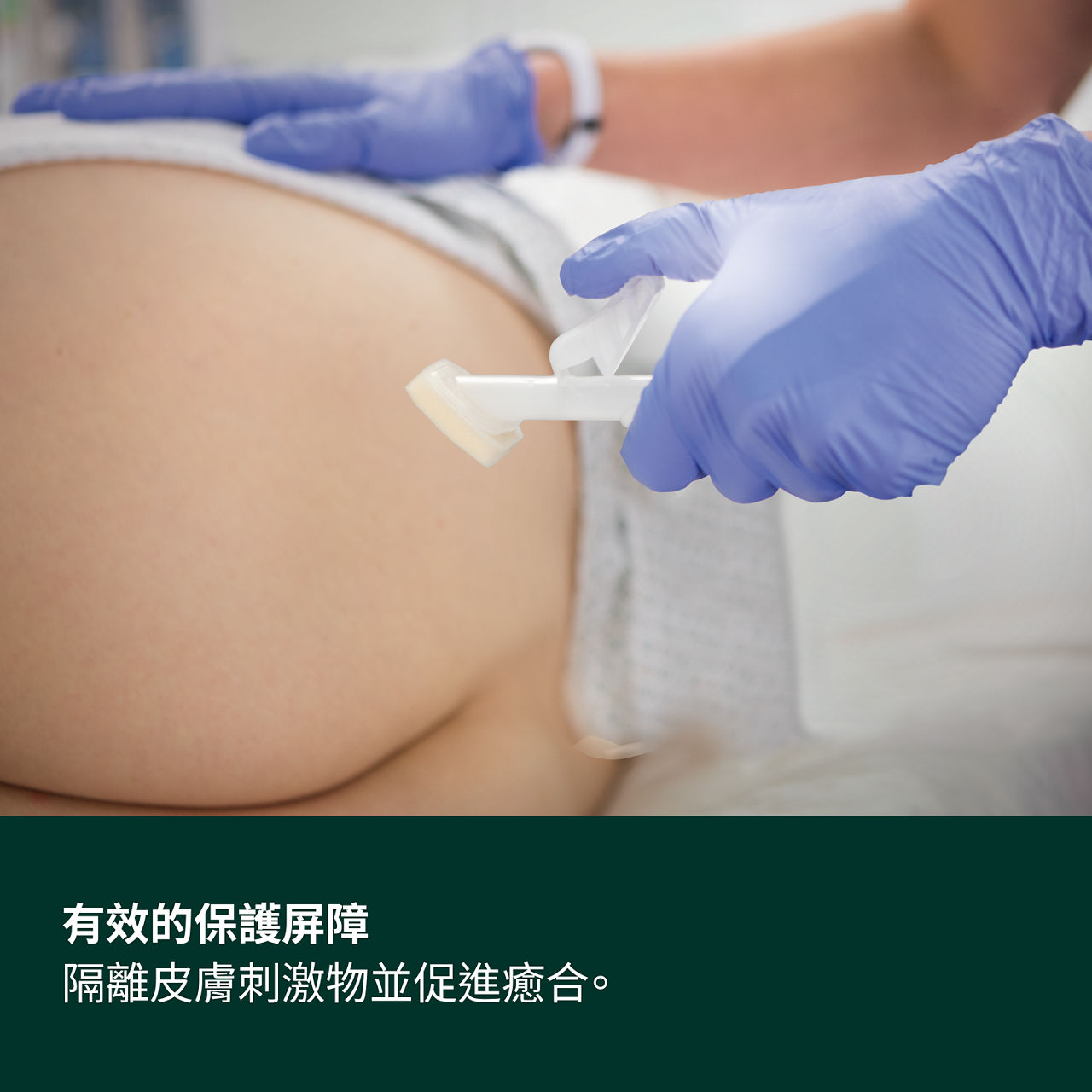 (3) Cavilon 高效皮肤保护剂：保护性屏障有效抵御皮肤刺激物