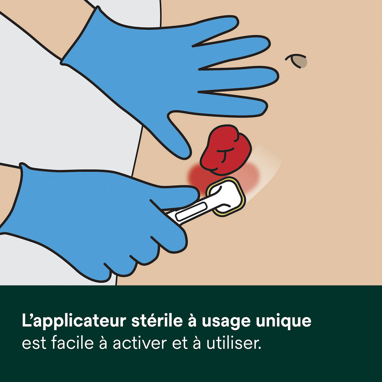 (5) Cavilon Advanced : L'applicateur stérile à usage unique est facile à activer et à utiliser