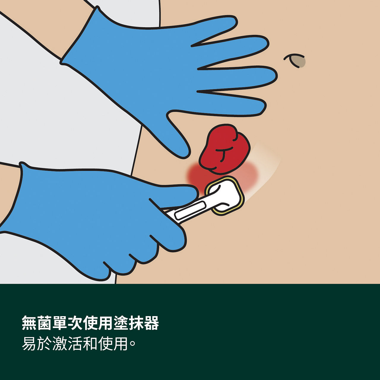 (5) Cavilon 進階皮肤保護劑：無菌單獨使用噴塗器，易於激活和使用
