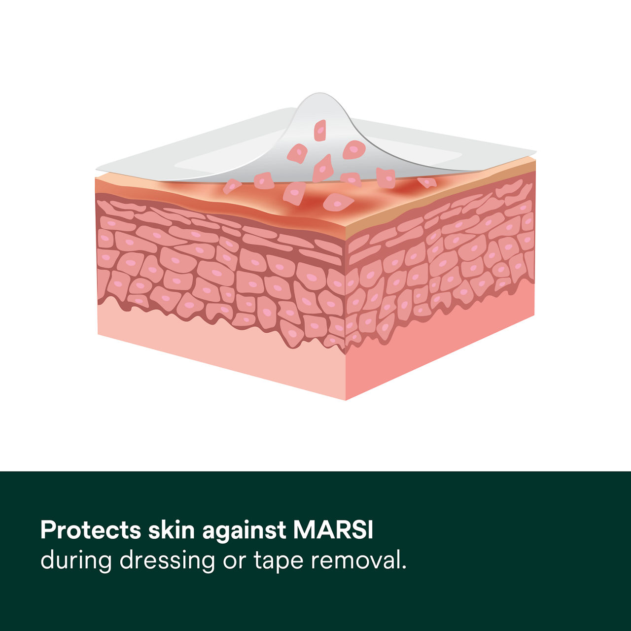 (2) Cavilon No Sting Barrier Film: Protects Skin Against MARSI during dressing or tape removal