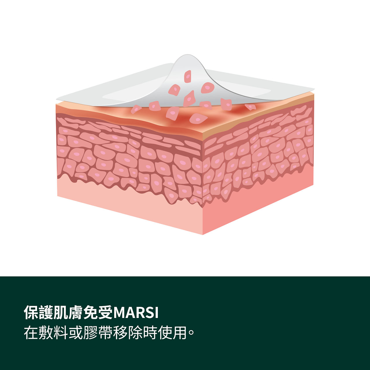 (2) Cavilon 無痛保膚膜：在敷料或膠帶移除過程中保護皮肤免受醫療黏附相關皮肤損傷 (MARSI)。