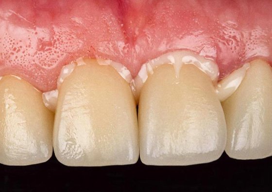 Cementation of final crowns