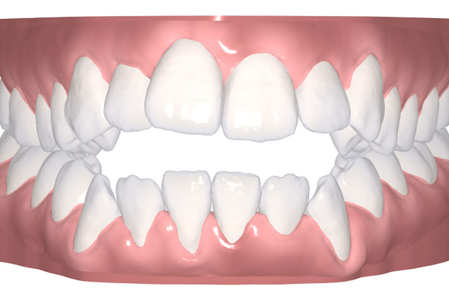 Oral Care Portal digital rendering of upper and lower teeth for aligners.