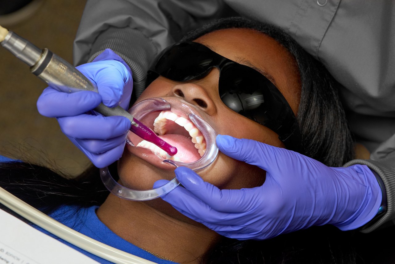 Prophy teeth where attachments will be bonded with an oil-free pumice or paste.