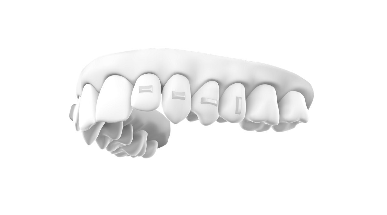 A digital dental cast of upper teeth has 3M Clarity Precision Grip Attachments affixed to four of them.