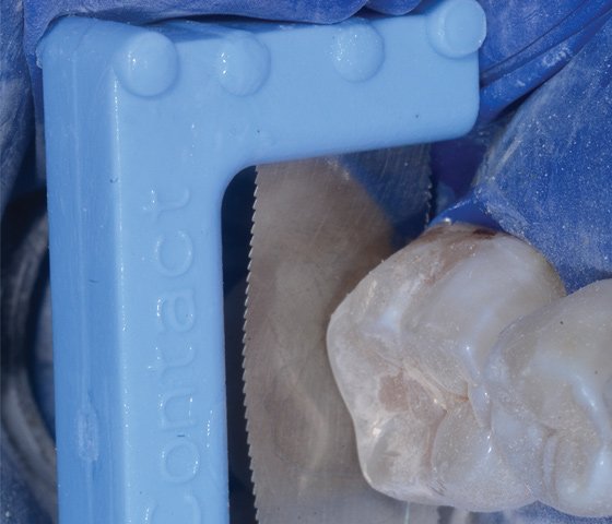 A TruContact Saw (Bioclear®) is used to clean and groom the unrestored mesial contact