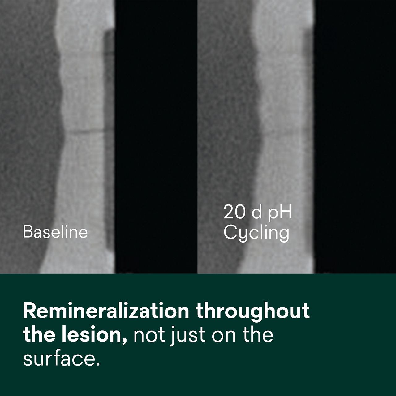 2 - Clinpro 5000: Remineralization throughout the lesion, not just on the surface