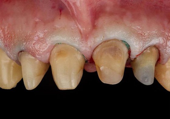 Composite core buildups