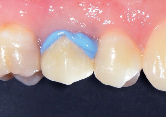 Try-in of the zirconia crown