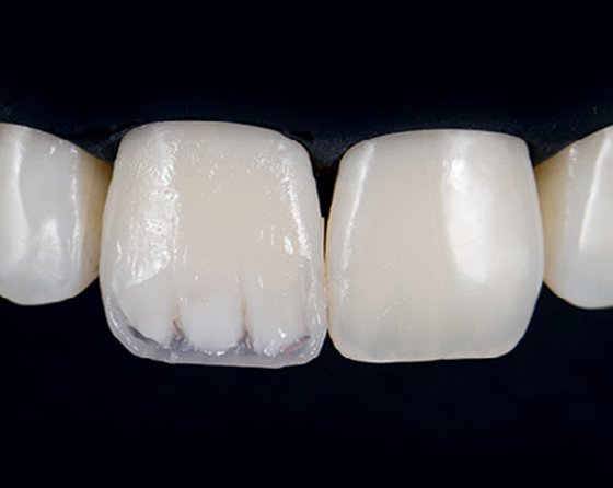 Dentin core is created and mamelons are added to mimic the appearance of the left central incisor