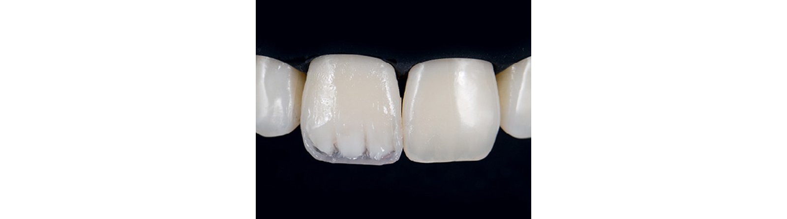 Dentin core is created and mamelons are added to mimic the appearance of the left central incisor